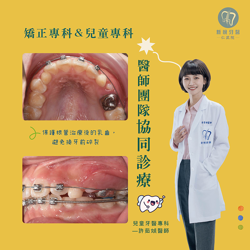 兒童矯正困難案例｜小佑的恆牙萌發挑戰的第2張圖片